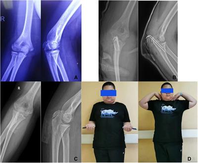 Outcomes of olecranon fractures in adolescents: comparison of tension band wiring and Herbert screw fixations